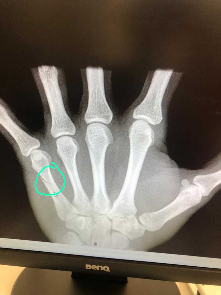 Тюменский лыжник сломал руку и пропустит чемпионат мира. Фото